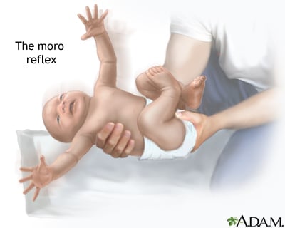 Moro reflex