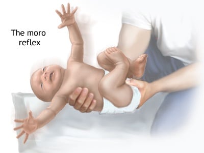 What the Moro reflex looks like.